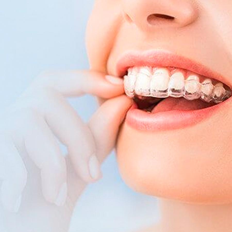 Invisalign clear aligners by Monahan Dentistry & Implant Center in Mesa, Az