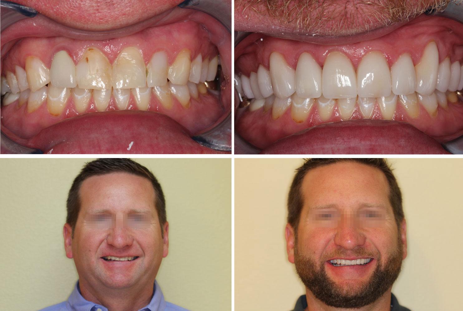 Full mouth smile makeover, man with great teeth