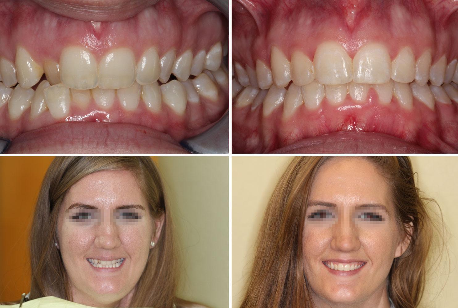 Orthodontics improved this young woman's smile