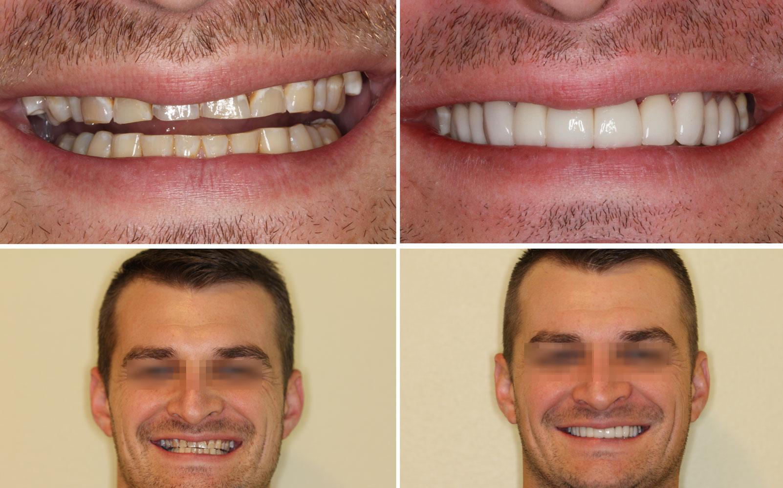 Dental crowns for fractured or broken tooth