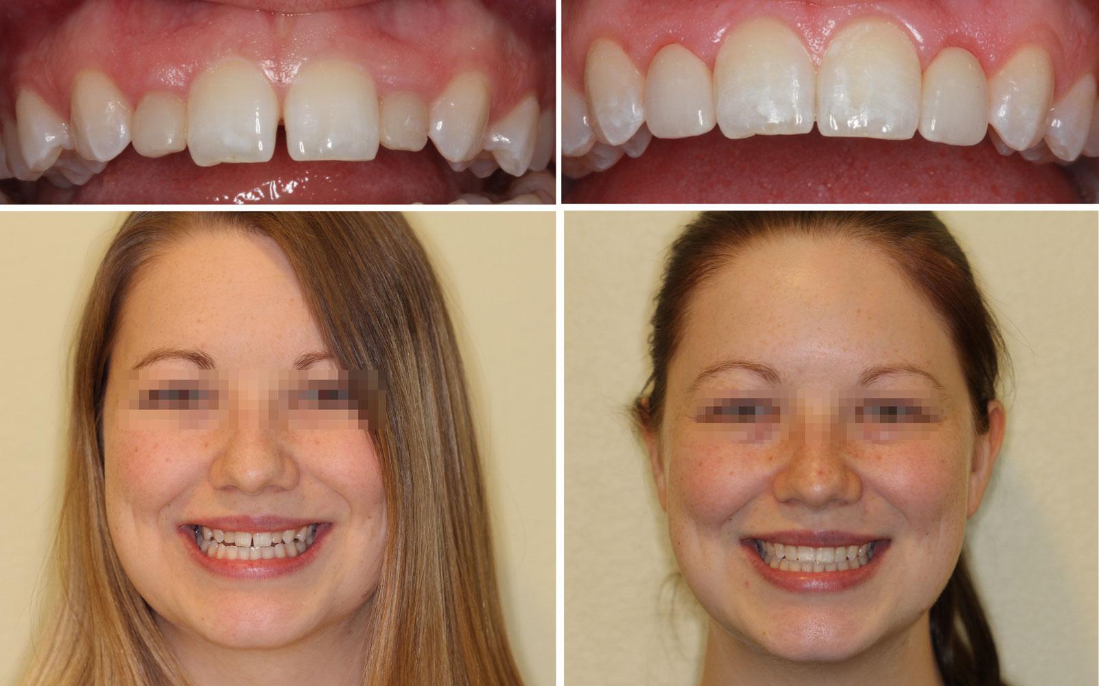How braces and veneers can improve your smile