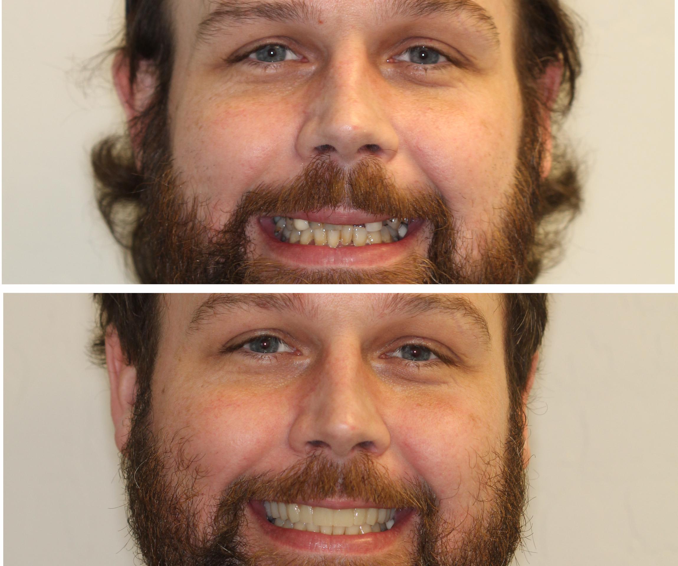 A man with a nice smile after dental implants in Mesa, Arizon