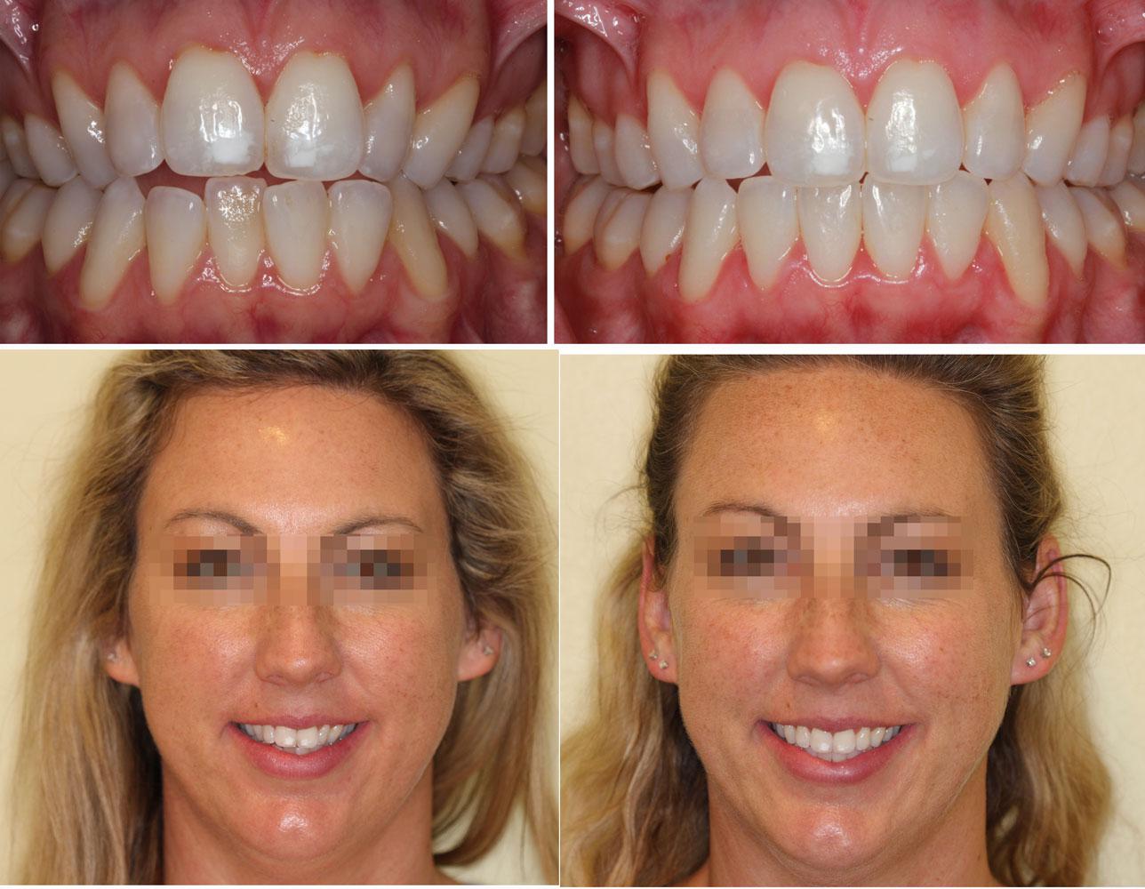 Invisalign can help improve your smile and facial features