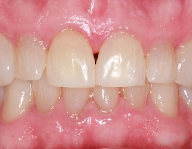 Whitening after